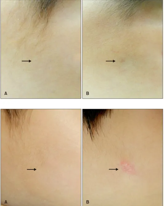 Fig. 4. Representative serial photo- photo-graphs of a patient in group A  be-fore surgery (A) and 6 months after surgery (B) on the left cheek