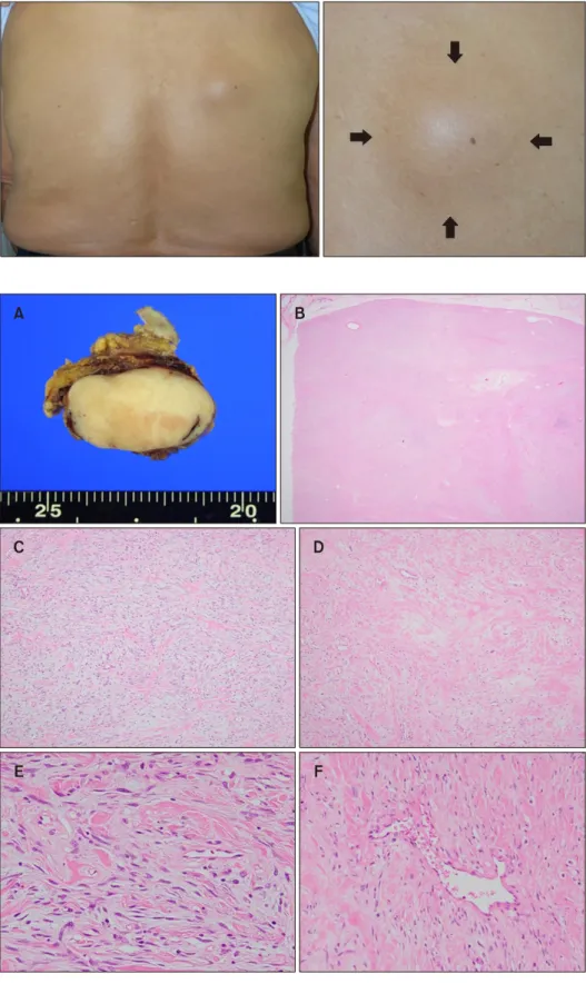 Fig. 1. Solitary, dome-shaped sub- sub-cutaneous mass on patient’s right  back.