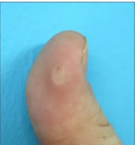 Fig. 1. Solitary hyperkeratotic non-movable papule on the flexor  surface of the distal phalanx of the left thumb