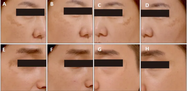 Fig. 1. (A, C) A 44-year-old woman with skin type IV at baseline, and (B, D) 2 weeks after five treatment sessions