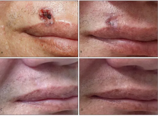 Fig. 1. Serial changes of basal cell  carcinoma skin lesion. (A) Before  punch biopsy