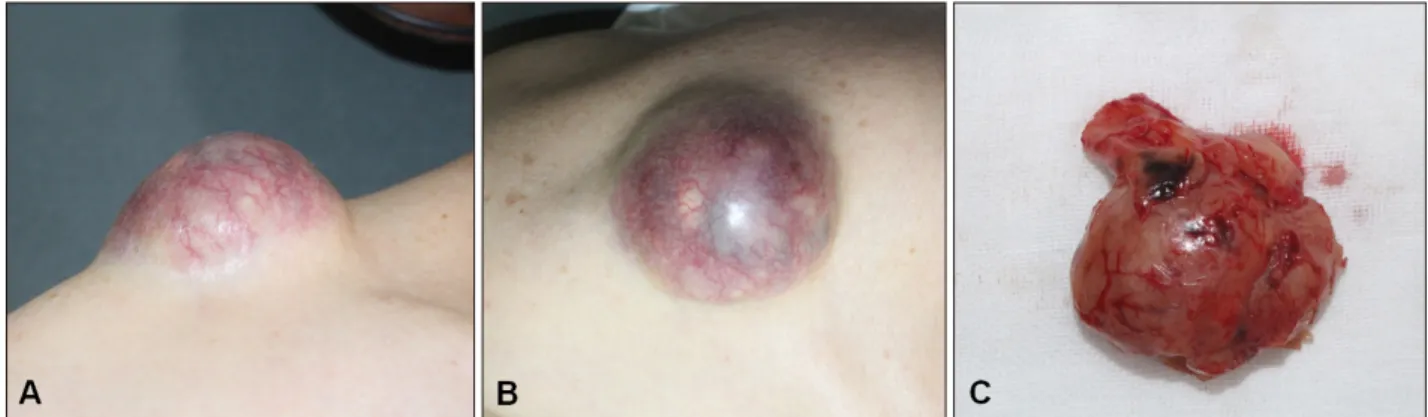Fig. 1. (A, B) A 5.0×4.3 cm-sized protruding mass on the right shoulder and (C) gross features of the excised tumor.