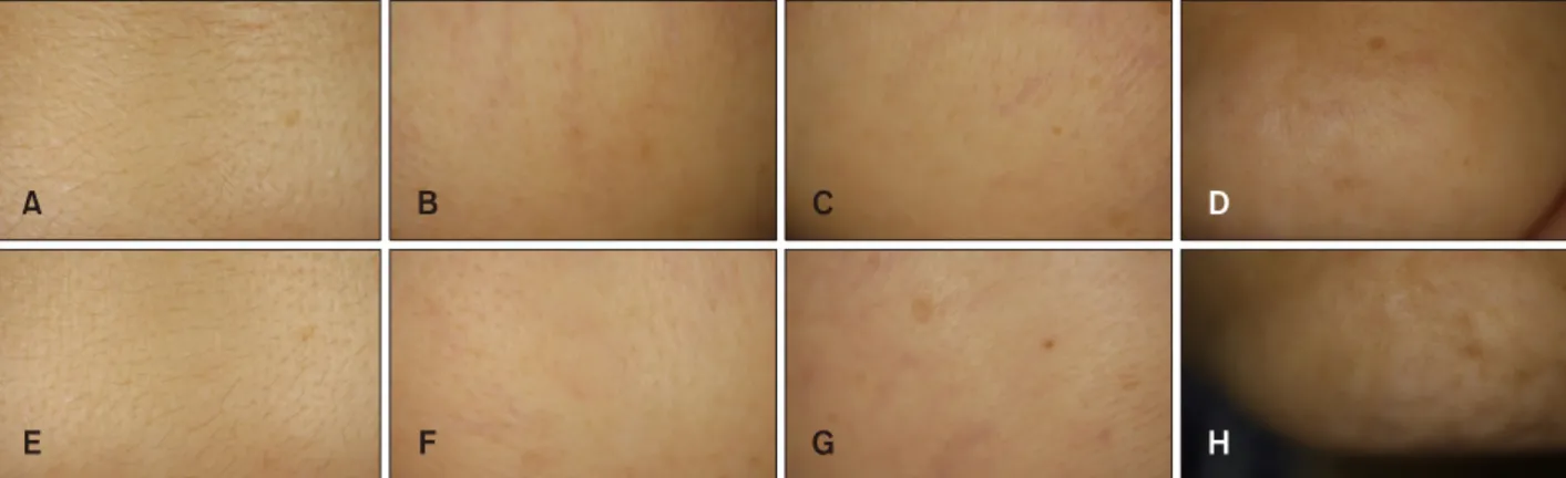 Fig. 1. (A∼D) Photographs of skin before light-emitting diode (LED) treatment. (A) Forehead, (B) left cheek, (C) right cheek, (D) chin
