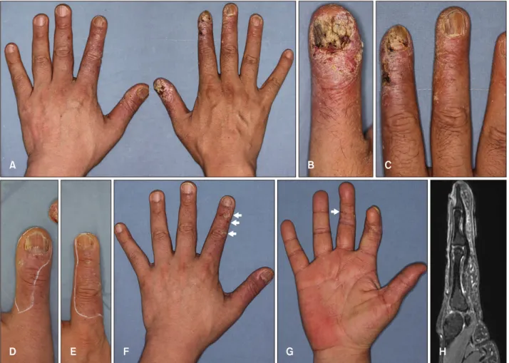 Fig. 1. Painful crusted necrotic plaques and scale widely distributed in the right thumb, index, and 3rd finger, and left thumb and  index finger