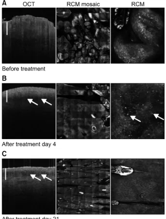 Fig. 2. Optical coherence tomography (OCT), overview reflect- reflect-ance confocal microscopy (RCM) mosaic, and single RCM  imaging in therapeutic follow-up: (A) Patient before treatment  with a verruciform lesion visible in OCT (1.8×0.6 mm, scale  bar=0.