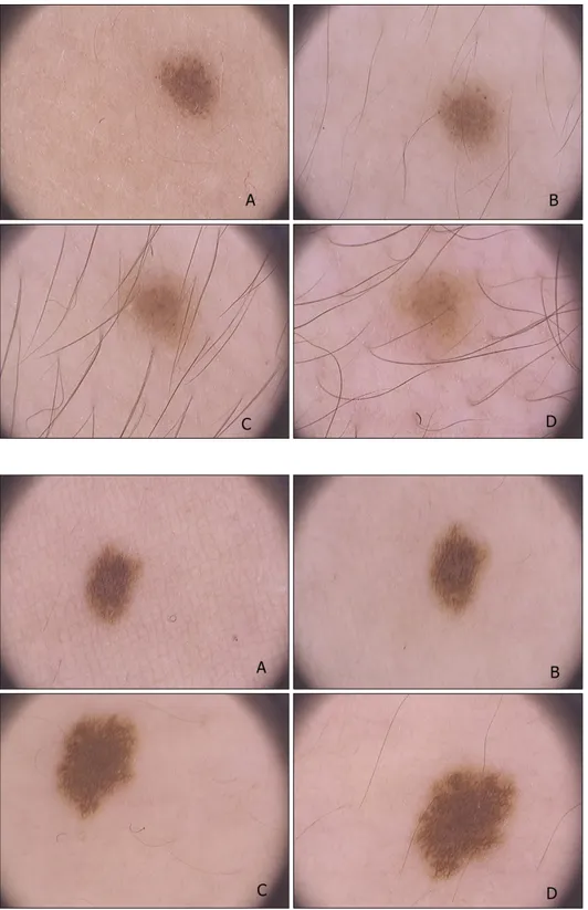 Fig. 3. A 10-year-old girl, nevus on  the back, dermoscopic change of  homogeneous pattern to reticular  pattern, enlargement of nevus (A: 