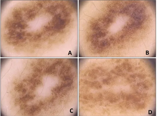 Fig. 4. A 12-year-old girl, nevus on  the back, dermoscopic change of  homogeneous-globular pattern to  homogeneous-reticular pattern (A: 