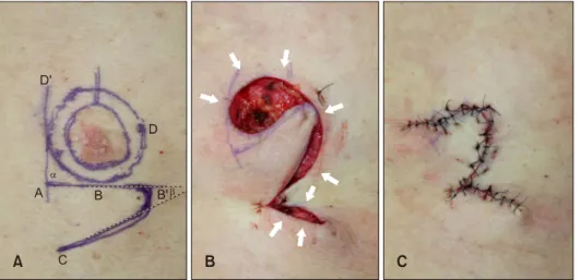 Fig. 1. Application of the slide-  swing skin flap. (A) Preoperative  design of the surgical excision with  safety margins and two flaps (DBB’
