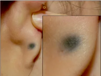 Fig. 2. Microscopic examination of  a biopsy specimen from a right  earlobe. (A) Discrete, fine, dark  granules and deposition of foreign  substance on the basement  membrane of eccrine sweat glands  (H&amp;E, ×400)