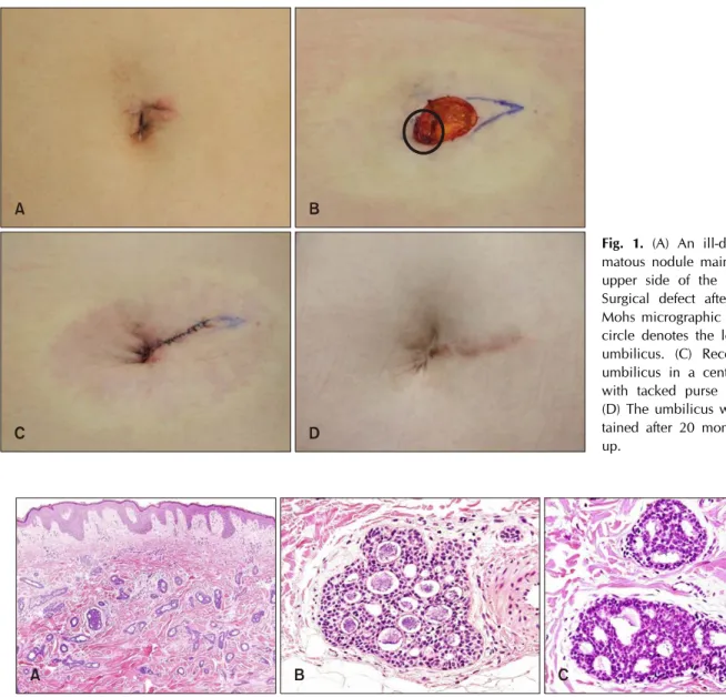 Fig. 1. (A) An ill-defined erythe- erythe-matous nodule mainly on the left  upper side of the umbilicus