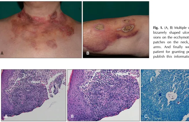 Fig. 1. (A, B) Multiple variable sized  bizarrely shaped ulcers and  ero-sions on the ecchymotic or reddish  patches on the neck, chest, and  arms