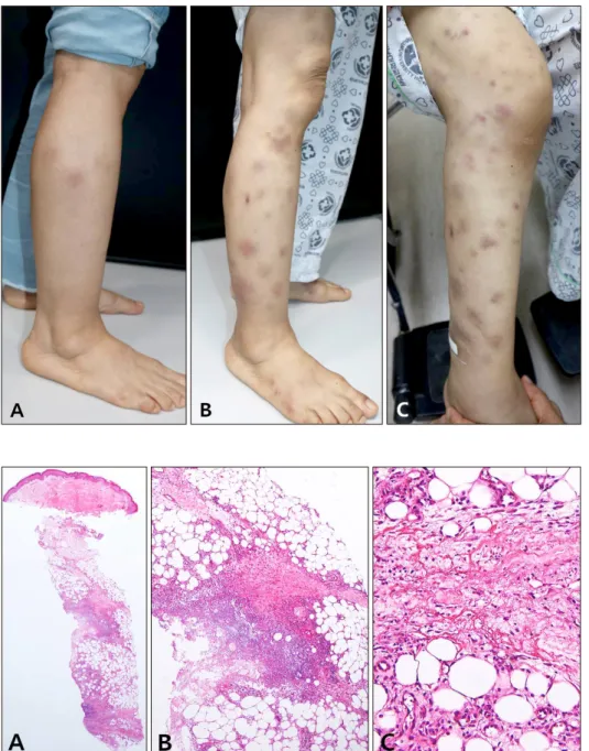 Fig. 1. Erythematous subcutaneous  nodules on the right leg at first visit  (A), 4 weeks (B), and 6 weeks later  (C)