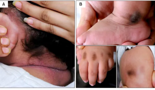 Fig. 1. (A) Multiple pear-like pa- pa-pules on head and neck area. (B)  Hyperpigmentation of the skin over  lateral malleolus,  metacarpophalan-geal joint of hand and the knee