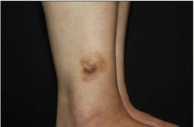 Fig. 1. A protruding solid nodule with a peripheral brownish  patch on the lower leg. 