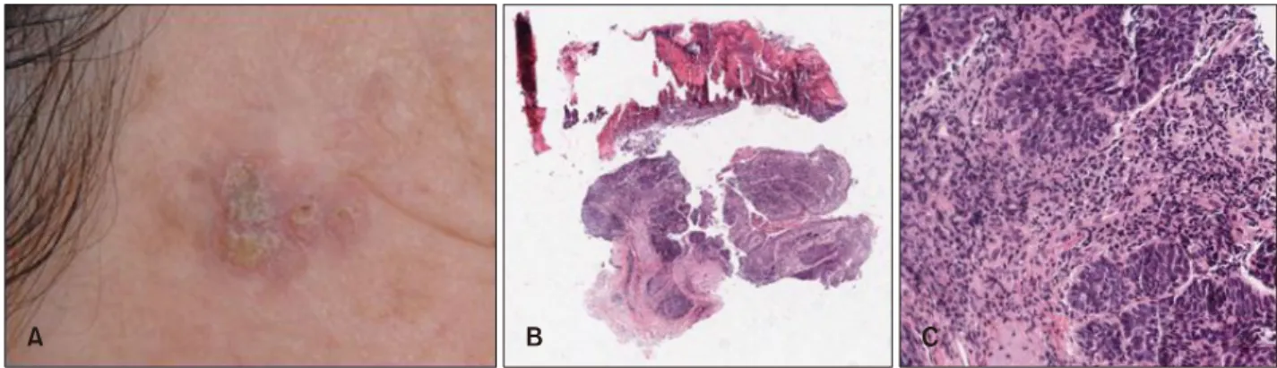 Fig. 1. Clinical and histopathologic features of squamous cell carcinoma (SCC). (A) Erythematous crusted plaque on the right temple