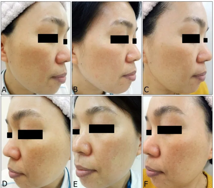 Fig. 3. Serial clinical photographs of a melasma patient with visibly widened capillaries on dermoscopy