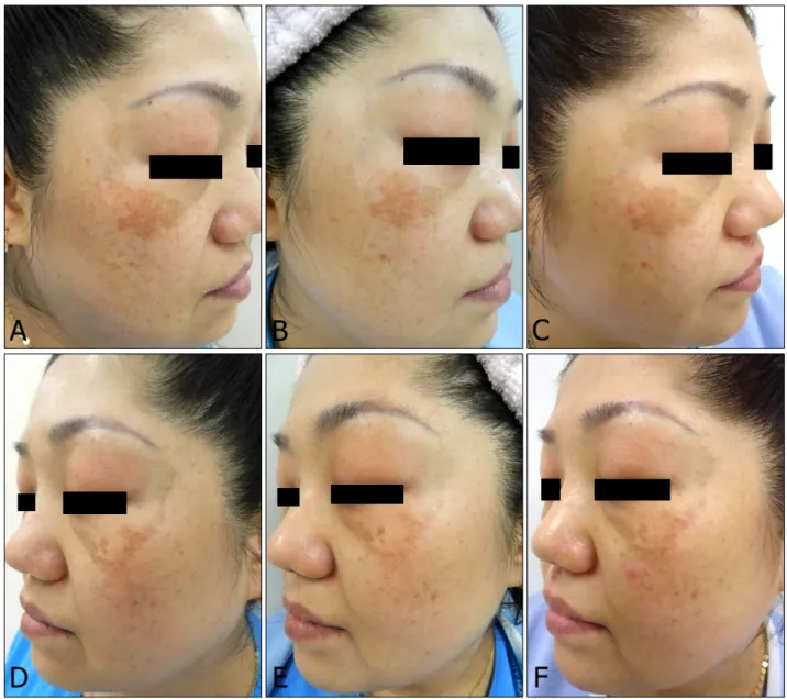Fig. 4. The patient who exhibited a rebound hyperpigmentation without purpura on pulsed-dye laser (PDL)+Q-switched Nd:YAG  laser (QSNY) side at week 16