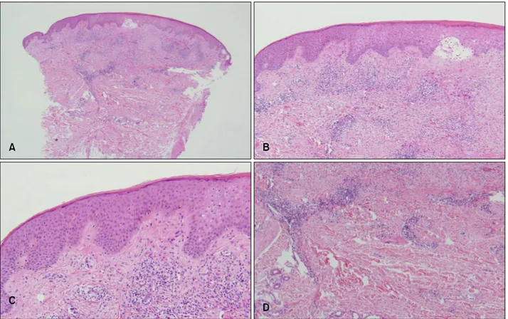 Fig. 3. (A) Lesions before the treatment. (B) Improved lesions after 1 month of treatment