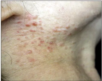 Fig. 1. Multiple erythematous, firm, non-tender papules of  various sizes (3∼7 mm) on the right side of the neck.