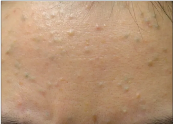 Fig. 1. Numerous pinhead- to matchhead-sized papules on  forehead.