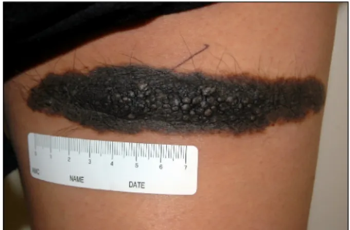 Fig. 1. Multiple papules and nodules arising in a black-colored,  slightly elevated plaque on the right posterior thigh during  pregnancy.