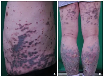 Fig. 1. (A) Scaly, violaceous to black-colored plaques and dusky  brown macules on trunk