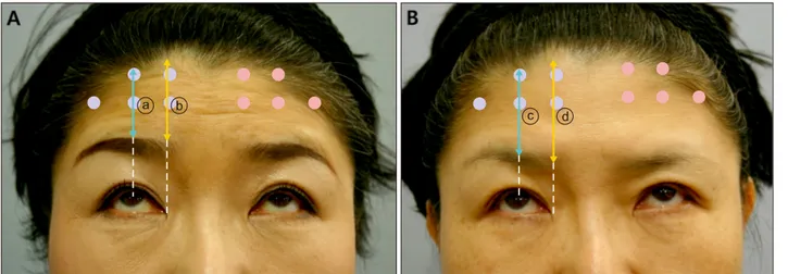 Fig. 1. (A) Photograph of Patient 1 with forced upward gaze before injection. The brow to hairline length was measured at the  mid-pupillary level (a blue line denoted as ⓐ) and the inner epicanthus level (a yellow line denoted as ⓑ) on either sides