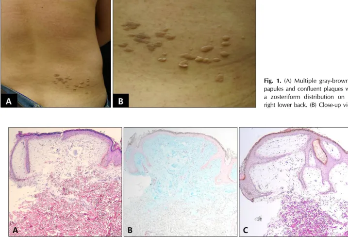 Fig. 1. (A) Multiple gray-brownish  papules and confluent plaques with  a zosteriform distribution on the  right lower back