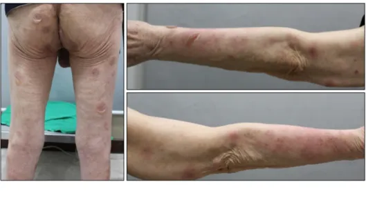 Fig. 1. Multiple erythematous tense  bullae on the buttock and both  extremities.