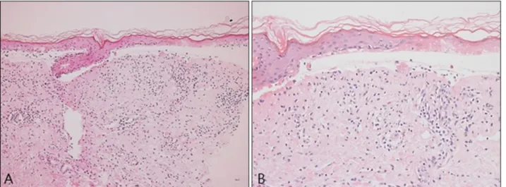 Fig. 2. (A) Biopsy specimens from the arm revealed a subepidermal split with bullae and epidermal necrosis (H&amp;E, ×100)