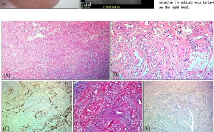 Fig. 1. (A) A slightly bluish to  skin-colored nodule about 1×1 cm  in size was found on his right heel