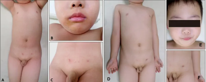 Fig. 1. Diffuse erythroderma involves the neck, trunk, and extremities with sandpaper-like coarseness (A), and perioral crust and fissure  (B) were observed