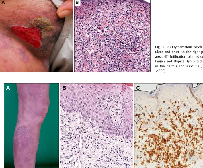 Fig. 1. (A) Erythematous patch with  ulcer and crust on the right pubic  area. (B) Infiltration of medium to  large sized atypical lymphoid cells  in the dermis and subcutis (H&amp;E, 