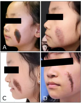 Fig. 6. (A) Photo before treatment. (B) Patient 15, who receives  23 sessions of intense pulsed light (IPL) and 5 sessions of erbium: 