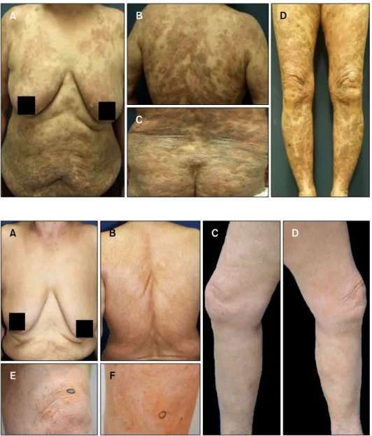 Fig. 1. (A∼D) The patient was  diagnosed with mycosis fungoides  (MF) 7 years ago. Erythematous and  brownish scaly oozing plaques on  the entire body