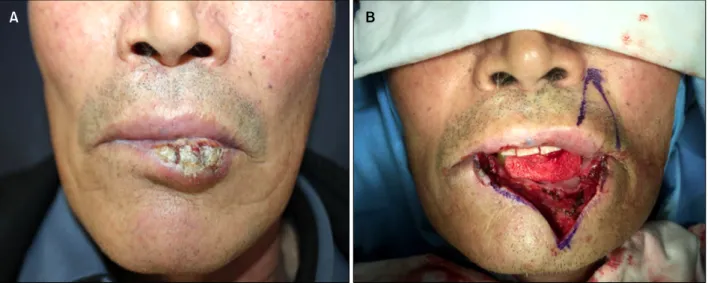 Fig. 1. (A) Clinical photograph of the lesion with extensive involvement of the mid-to-left portion of the lower lip