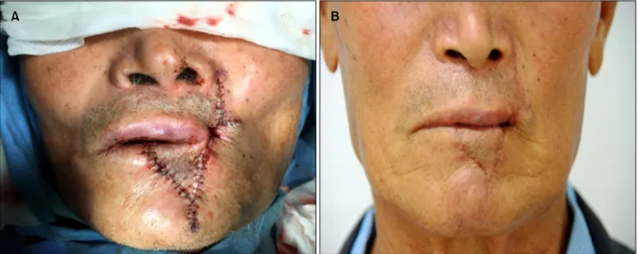 Fig. 2. (A) At completion of the first stage operation and (B) 8 weeks postoperative. 