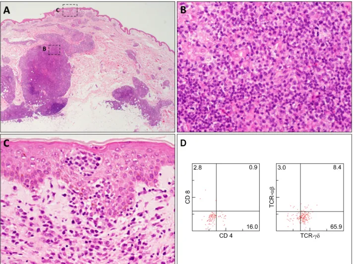 Fig. 2. (A) Histology of a biopsy specimen of an erythematous plaque showing focal infiltrates of atypical lymphocytes in the dermis