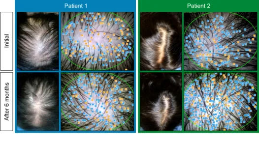 Fig. 4. Effectiveness of hair regrowth  in 2 patients with female pattern  hair loss after 6 months of  treat-ment.