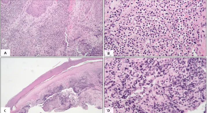 Fig. 2. Intraepithelial abscess and necrotic debris infiltrated by inflammatory cells mainly composed of polymorphonuclear neutrophils  were observed in histopathologic finding