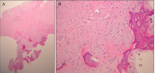 Fig. 2. (A) The lesion had variable  cellularity and consisted of a mixture  of loosely or compactly arranged  fibroblasts and trabeculae of the  bone showing varying degrees of  maturation (H&amp;E, ×40)