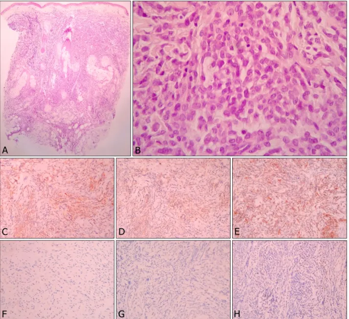 Fig. 2. (A) The tumor is composed of diffuse cellular infiltrate in the entire dermis and subcutis, with an overlying Grenz zone (H&amp;E, 