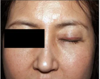 Fig. 1. Erythematous linear papules along left upper eyelid.