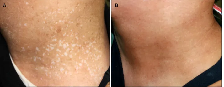 Table 1. Summary of case reports on the treatment of laser therapy-induced punctate leukoderma