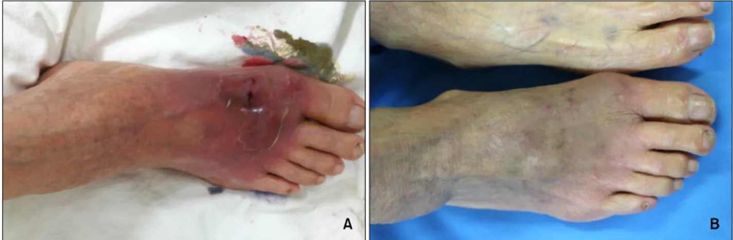 Fig. 1. (A) Painful erythematous purpuric swelling with scales on the dorsal surface of the right foot