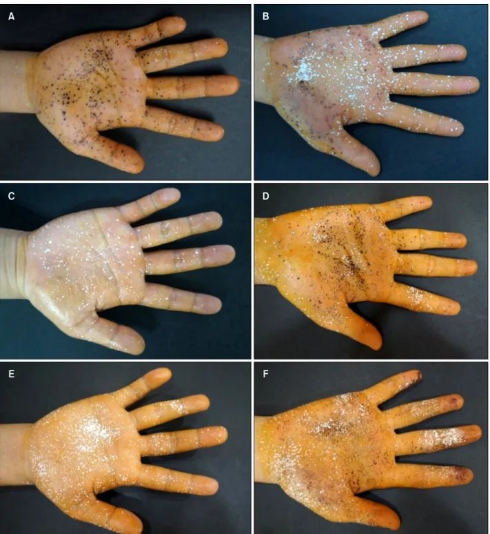 Fig. 2. Representative results of the starch-iodine test at baseline (A, B), immediate after completing the 10 times of treatment (C,  D), and 1 week after completing the treatment (E, F) in patient group A and group B, respectively