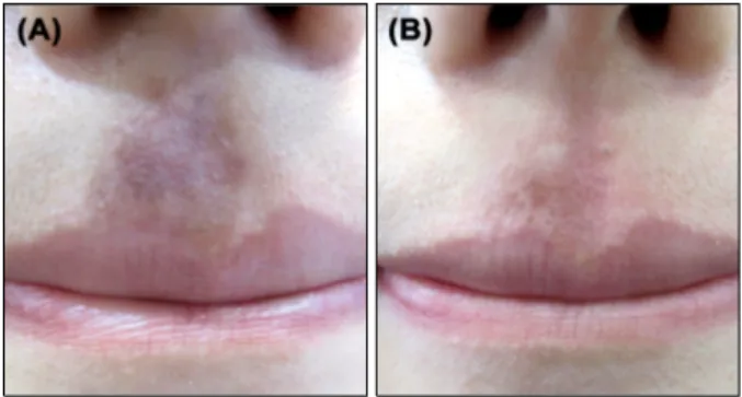 Fig. 3. Post-inflammatory hyperpigmentation in a 20-year-old  female. (A) Findings at baseline