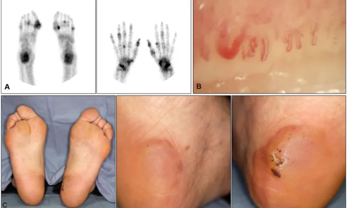Fig. 2. (A) The low power view  shows diffuse palisading  granulo-matous infiltrations in the entire  dermis (H&amp;E, ×40)
