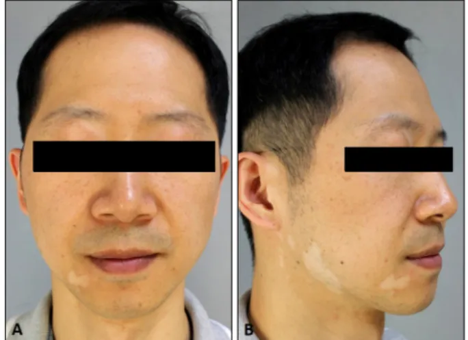 Fig. 1. Type II segmental vitiligo showing multiple irregular  bordered hypopigmented patches on right facial area: upper  medial eyelid and perioral area (A), mainly on mandibular and  auricular are (B).