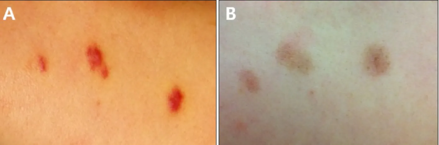 Fig. 2. Immunohistochemical evaluation of classic Kaposi’s sarcoma specimens. (A) Endothelial cells of the abnormal vessels staining  positively for cluster of differentiation 31; (B) Spindle cells staining positively for Friend leukemia virus integration-